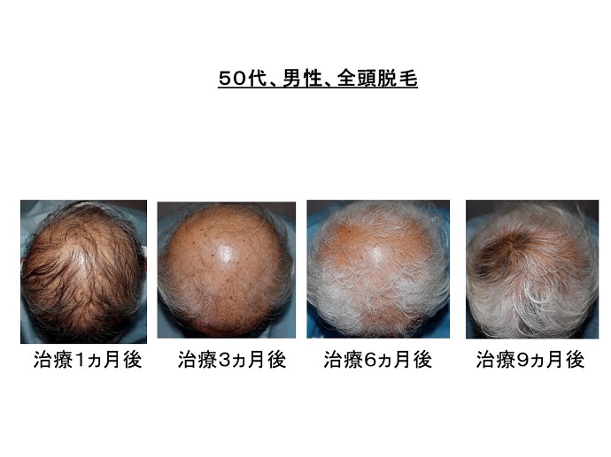 円形脱毛症　病院